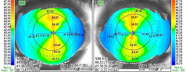 Corneal topography with the rule astigmatism